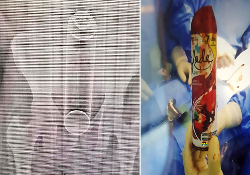 HD Homem vai parar ao hospital com um ambientador 